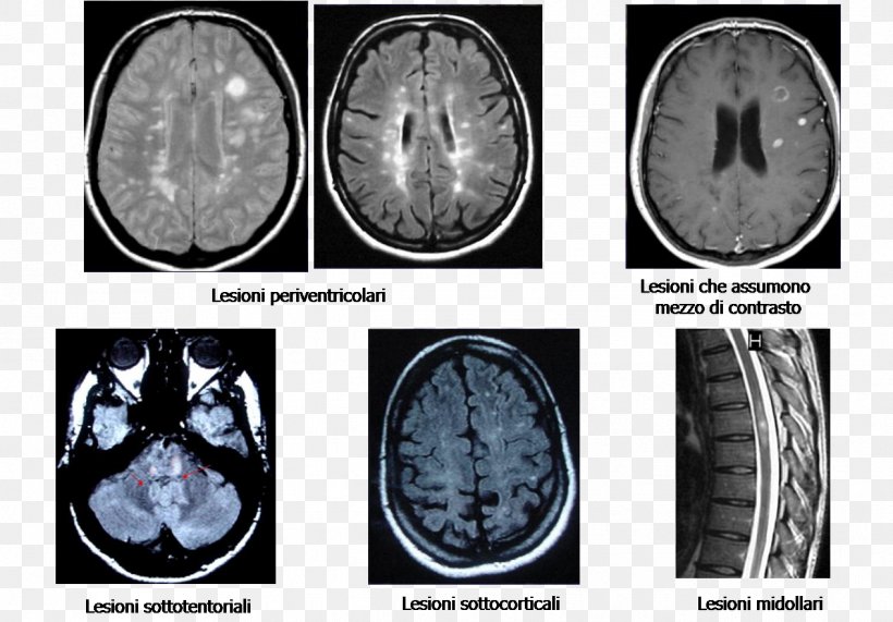 Brain Multiple Sclerosis Magnetic Resonance Imaging Disease, PNG, 1266x882px, Watercolor, Cartoon, Flower, Frame, Heart Download Free