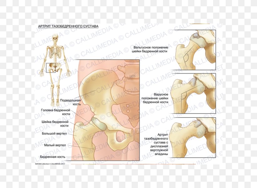 Hip Dysplasia Bone Arthritic Pain Femur, PNG, 600x600px, Watercolor, Cartoon, Flower, Frame, Heart Download Free