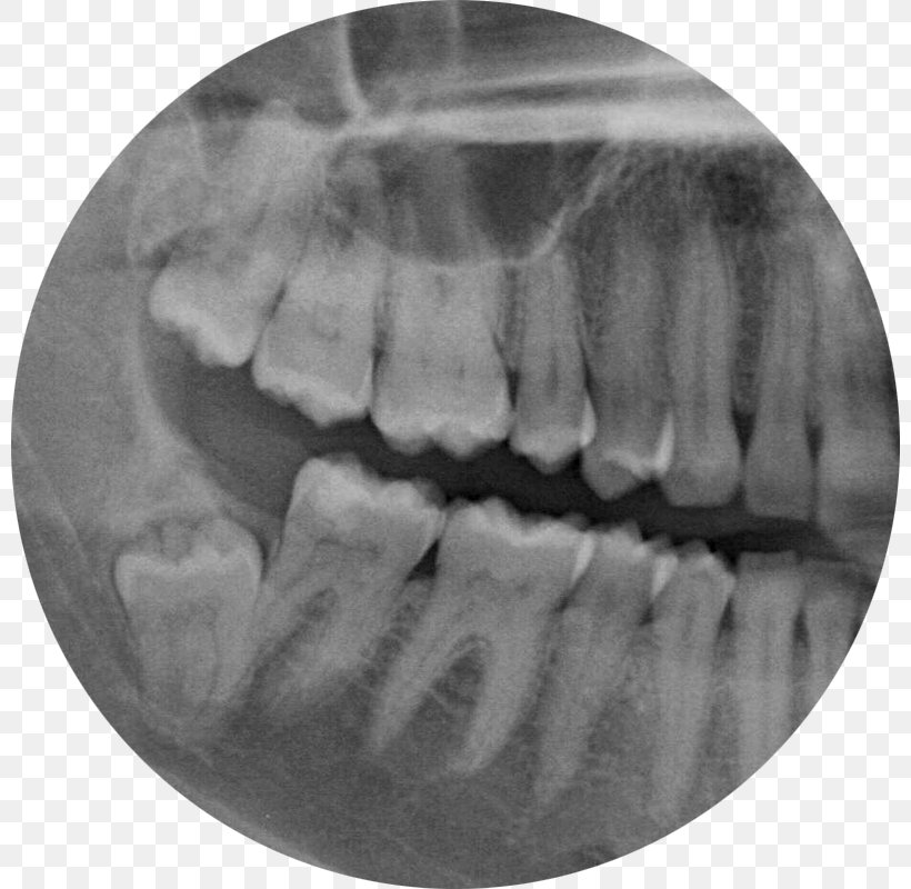 Wisdom Tooth Dental Extraction Jaw Trigeminal Nerve, PNG, 800x800px, Wisdom Tooth, Ache, Black And White, Dental Extraction, Dentistry Download Free