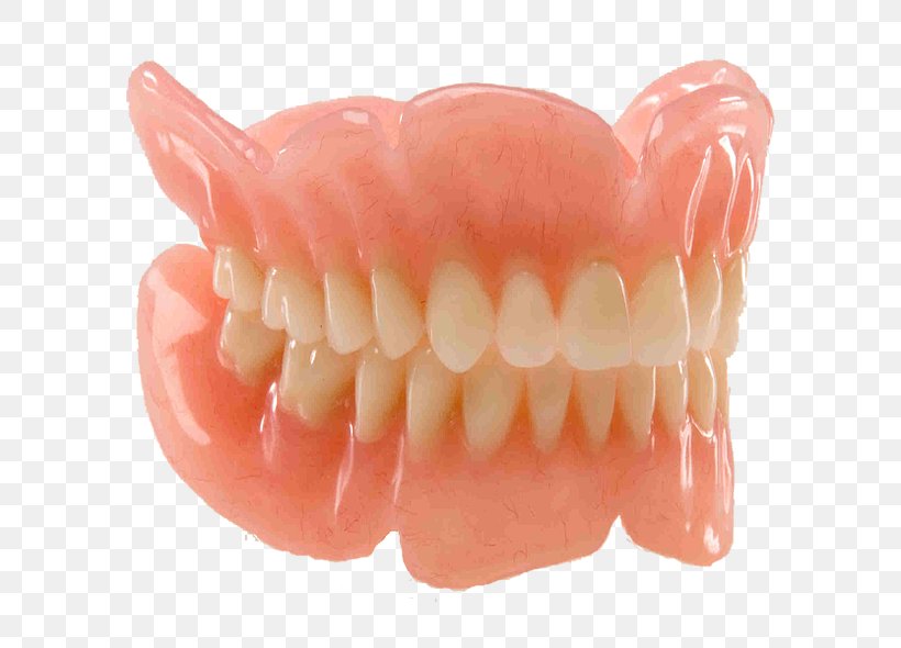 Dentures Dentistry Removable Partial Denture Prosthesis Dental Implant, PNG, 590x590px, Dentures, Bridge, Clinic, Dental Implant, Dental Laboratory Download Free
