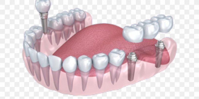 Tooth Dental Implant Dentistry Crown, PNG, 1000x500px, Watercolor, Cartoon, Flower, Frame, Heart Download Free