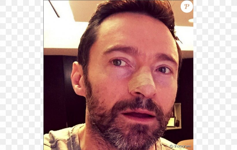 Hugh Jackman The Wolverine Sunscreen Skin Cancer Basal-cell Carcinoma, PNG, 950x601px, Hugh Jackman, Actor, Basalcell Carcinoma, Beard, Cancer Download Free