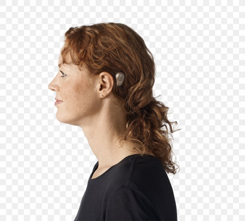 Bone-anchored Hearing Aid Ear Pain Cochlear Implant, PNG, 1000x903px, Boneanchored Hearing Aid, Bone Conduction, Brown Hair, Chin, Cochlear Implant Download Free