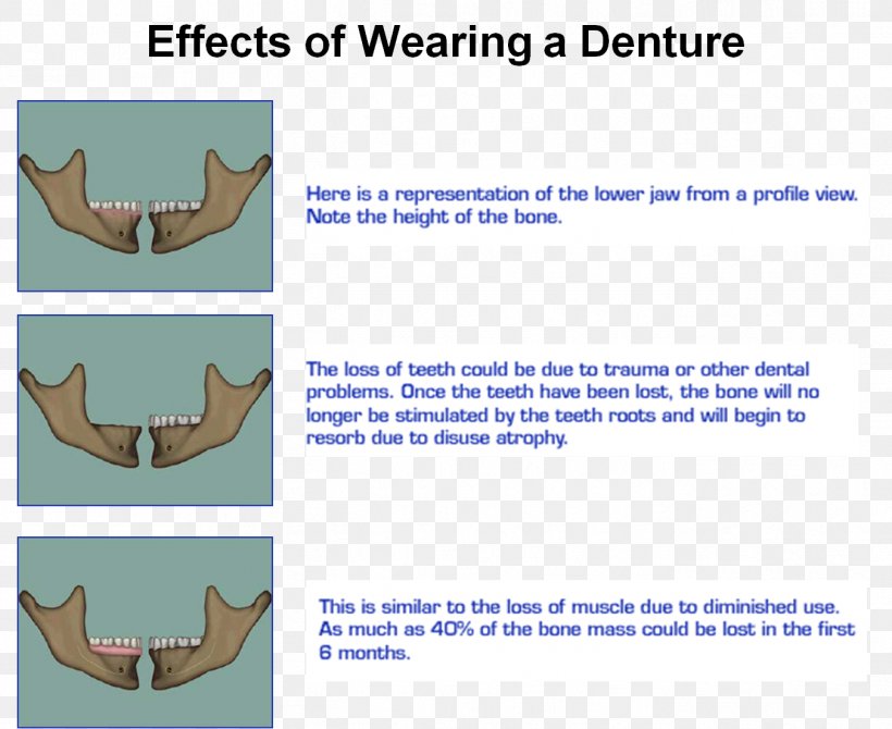 Jaw Mandible Bone Resorption Alveolar Process Maxilla, PNG, 1352x1106px ...