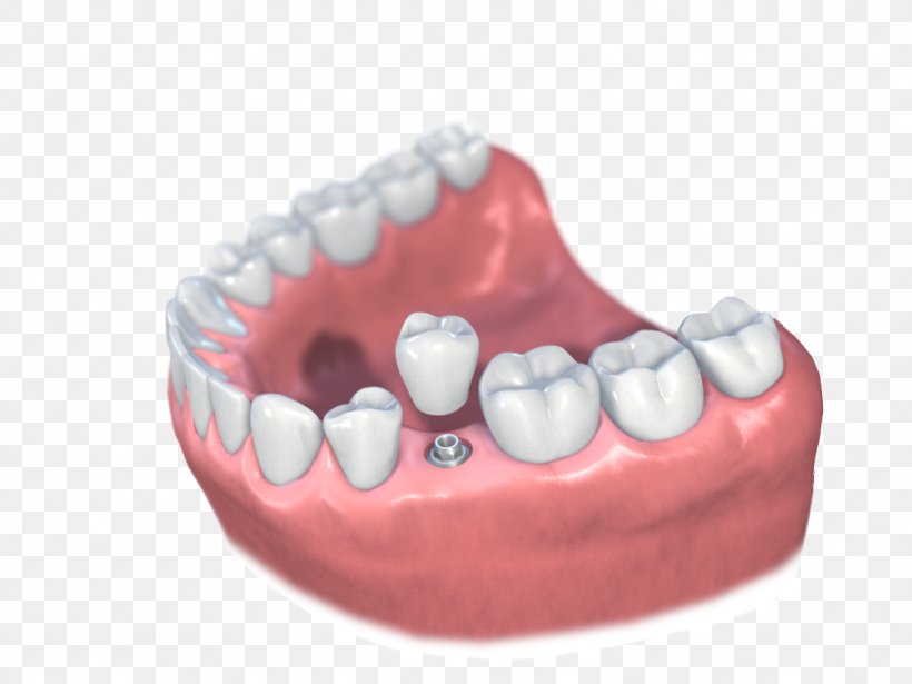 Dental Implant Dentistry Implantology Prosthesis, PNG, 1024x768px, Dental Implant, Crown, Dental Surgery, Dentist, Dentistry Download Free