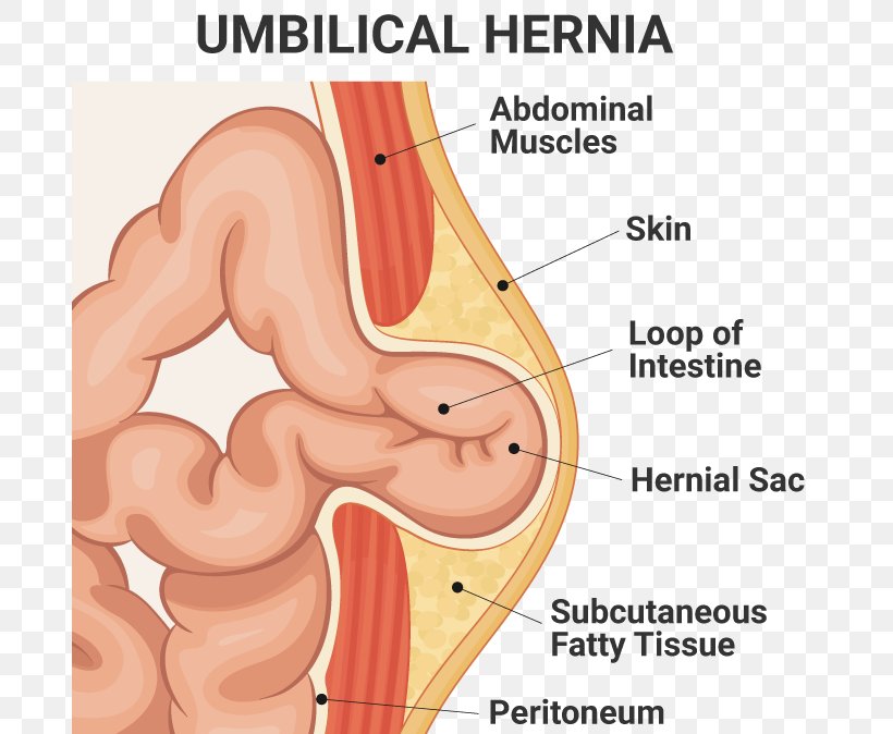 Umbilical Hernia Hernia Repair Inguinal Hernia Surgery, PNG, 688x674px, Watercolor, Cartoon, Flower, Frame, Heart Download Free