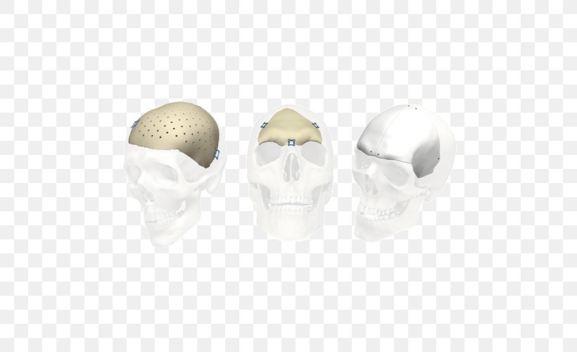 Skull Stryker Corporation Implant Jaw Bone, PNG, 500x500px, Skull, Bone, Dentistry, Dura Mater, Health Download Free