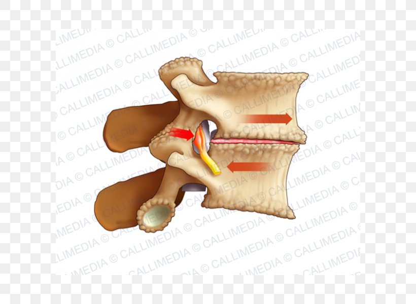Osteoarthritis Lumbar Vertebrae Pain Arthrodesis Sciatica, PNG, 600x600px, Osteoarthritis, Anatomy, Arthritis, Arthrodesis, Chronic Pain Download Free