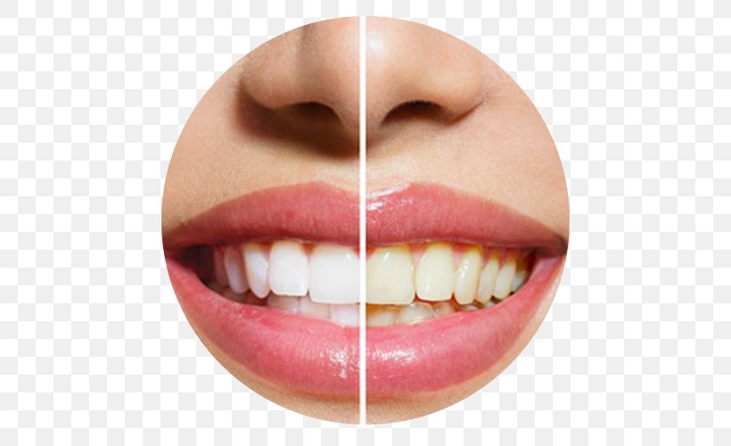 Lee And Van Mieghem DDS Cosmetic Dentistry Tooth Whitening, PNG, 500x500px, Dentistry, Chin, Clear Aligners, Cosmetic Dentistry, Dental Sealant Download Free