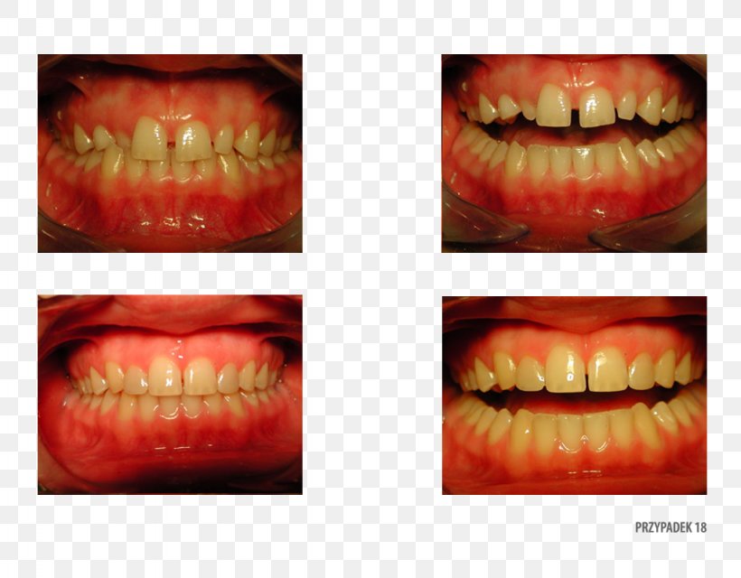 Gums Camera Gingivoplasty Ortoprotex Tooth, PNG, 1024x800px, Gums, Camera, Clinic, Close Up, Closeup Download Free