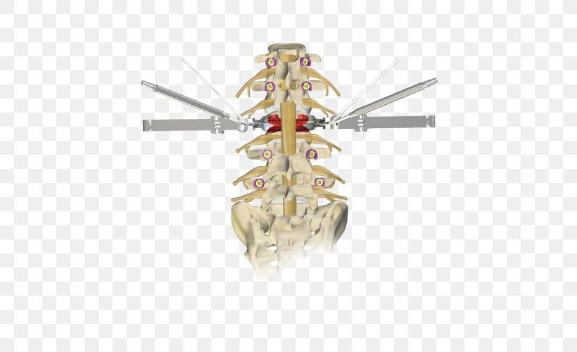 Osteotomy Vertebral Column Surgery Kyphosis Lumbar Vertebrae, PNG, 500x500px, Osteotomy, Bone, Cervical Vertebrae, Hospital, Kyphosis Download Free