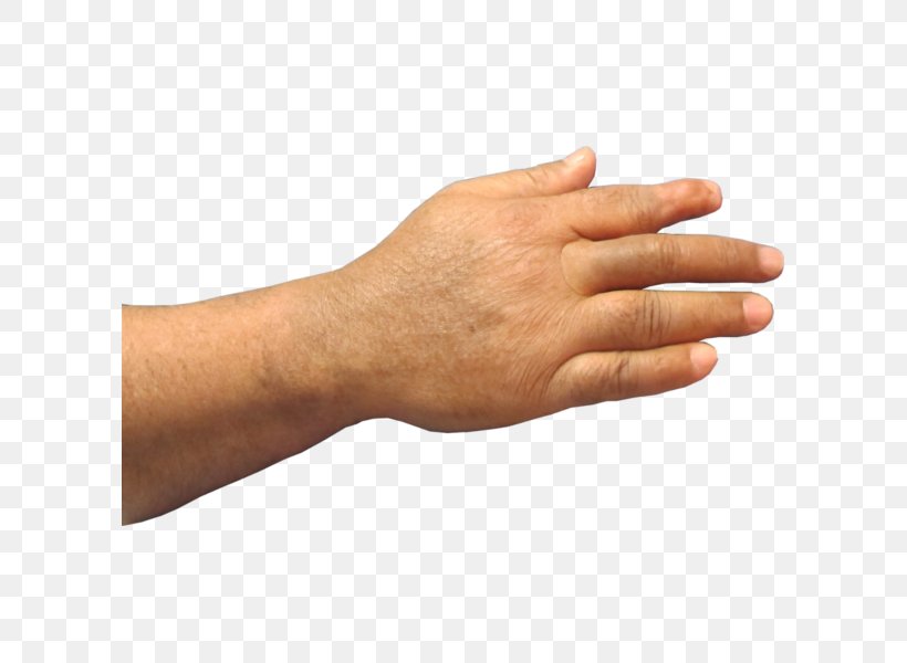 Thumb Prosthesis Hand Amputation Finger, PNG, 600x600px, Thumb, Aesthetics, Amputation, Arm, Disability Download Free