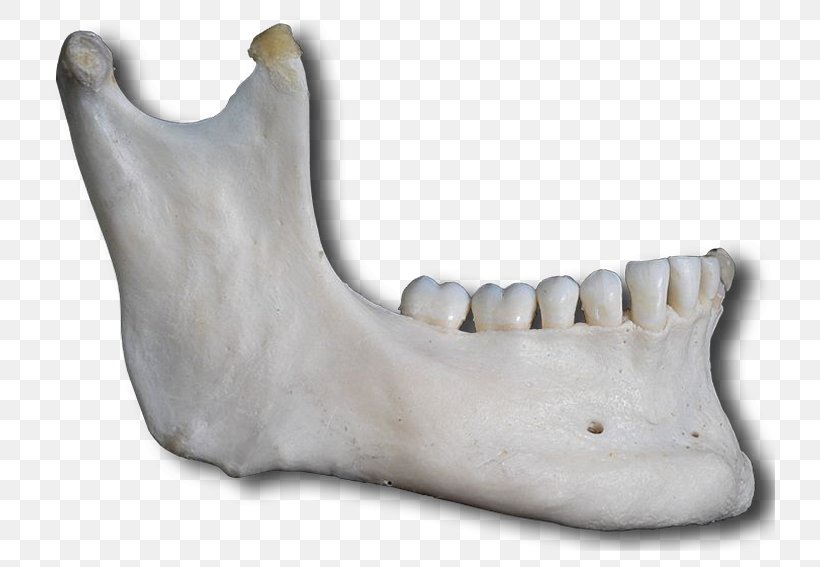 Jaw Mandible Facial Skeleton Bone Anatomy, PNG, 739x567px, Jaw, Anatomy, Bone, Face, Facial Skeleton Download Free