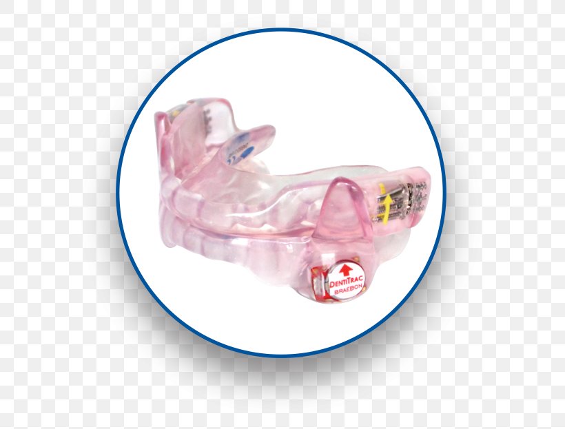 Mandibular Advancement Splint Patient Sleep Apnea Bowie Positive Airway Pressure, PNG, 600x623px, Mandibular Advancement Splint, Apnea, Bowie, Continuous Positive Airway Pressure, Dentist Download Free