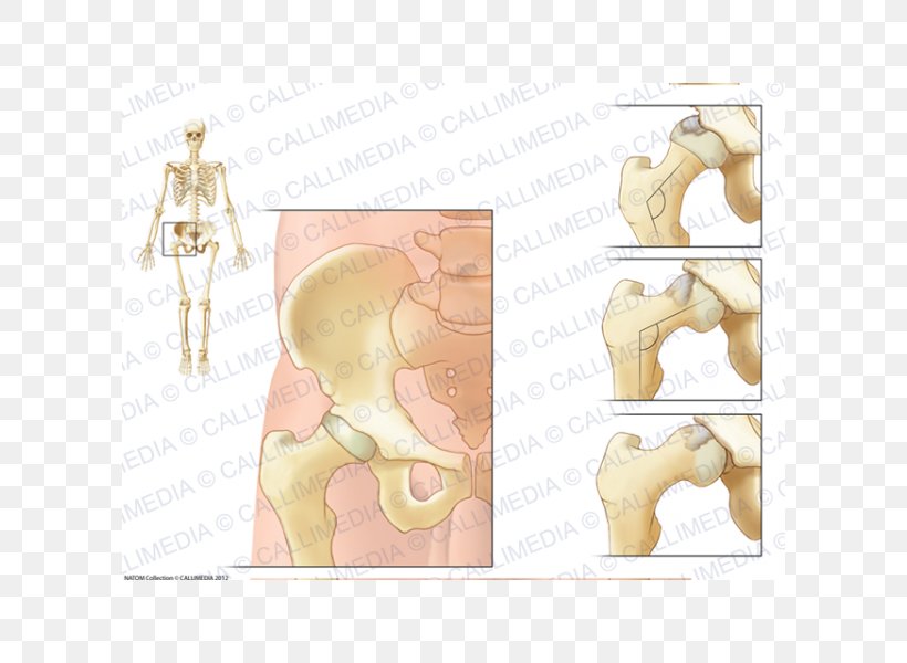 Hip Arthritis Femur Greater Trochanter Lesser Trochanter, PNG, 600x600px, Watercolor, Cartoon, Flower, Frame, Heart Download Free