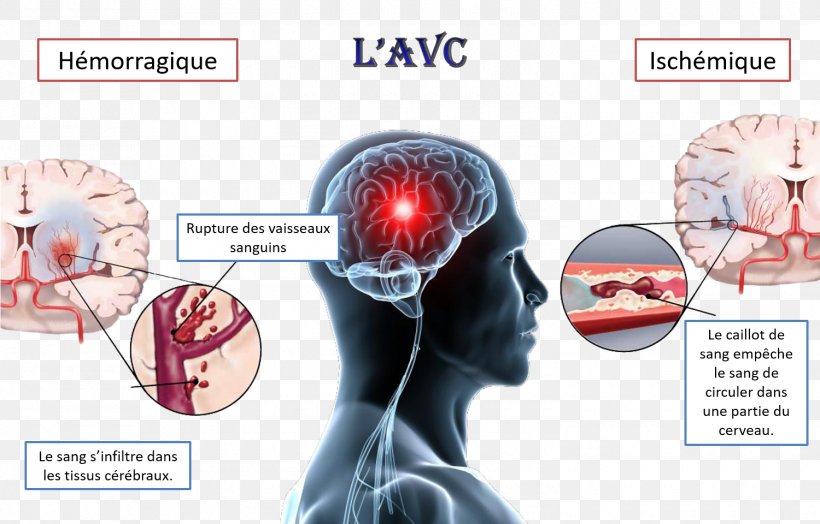 Stroke Transient Ischemic Attack Ischemia Stanley L. Goodman M.D. Disease, PNG, 1500x960px, Watercolor, Cartoon, Flower, Frame, Heart Download Free