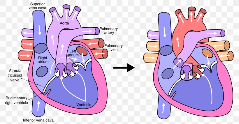 Fontan Procedure Heart Surgery Tricuspid Atresia Pulmonary Artery, PNG, 2000x1040px, Watercolor, Cartoon, Flower, Frame, Heart Download Free