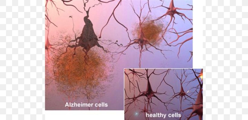 Alzheimer's Disease Alzheimer's Association Brain Amyloid Beta Senile Plaques, PNG, 725x399px, Brain, Amyloid, Amyloid Beta, Brain Injury, Branch Download Free