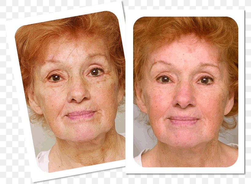 Wrinkle Anti-aging Cream Laser Surgery Skin, PNG, 791x600px, Wrinkle, Acne, Ageing, Antiaging Cream, Cheek Download Free