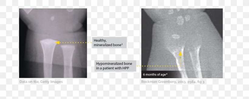 Hypophosphatasia Bone Rickets Osteomalacia Radiology, PNG, 1149x461px, Bone, Bone Fracture, Bone Pain, Brand, Disease Download Free