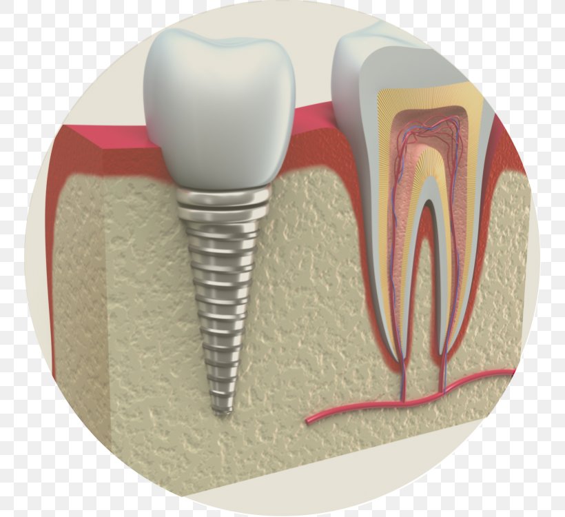 Dental Implant Periodontal Disease Dentistry Periodontology, PNG, 750x750px, Watercolor, Cartoon, Flower, Frame, Heart Download Free