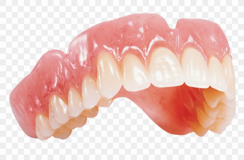 Dentures Removable Partial Denture Dentistry Dental Laboratory Crown, PNG, 1280x840px, Dentures, Bridge, Crown, Dental Implant, Dental Laboratory Download Free
