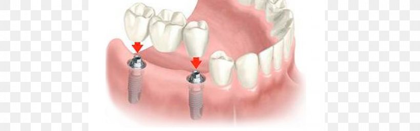 Dental Implant Dentistry Bridge Dentures, PNG, 960x300px, Watercolor, Cartoon, Flower, Frame, Heart Download Free