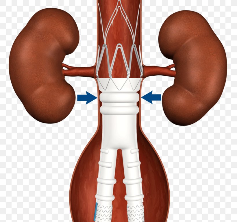 Stenting Endovascular Aneurysm Repair Graft Abdominal Aortic Aneurysm Aorta, PNG, 768x768px, Watercolor, Cartoon, Flower, Frame, Heart Download Free