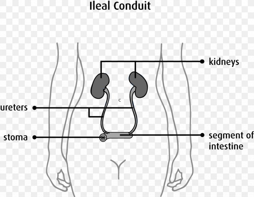 Stoma Urostomy Urinary Diversion Urine Ostomy Pouching System, PNG, 922x716px, Watercolor, Cartoon, Flower, Frame, Heart Download Free