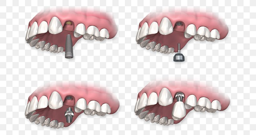 Dental Implant Dentistry Dentures, PNG, 697x435px, Dental Implant, Abutment, Bone, Crown, Dentist Download Free