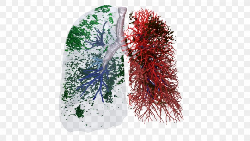 European Respiratory Society Idiopathic Pulmonary Fibrosis Respiratory Tract Chronic Obstructive Pulmonary Disease Lung, PNG, 1024x576px, Idiopathic Pulmonary Fibrosis, Computed Tomography, Disease, Inhalation, Long Tail Keyword Download Free