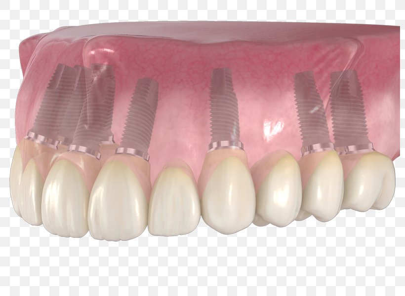 Tooth Dentures Prosthesis Head Nail, PNG, 800x600px, Tooth, Dentures, Finger, Head, Jaw Download Free