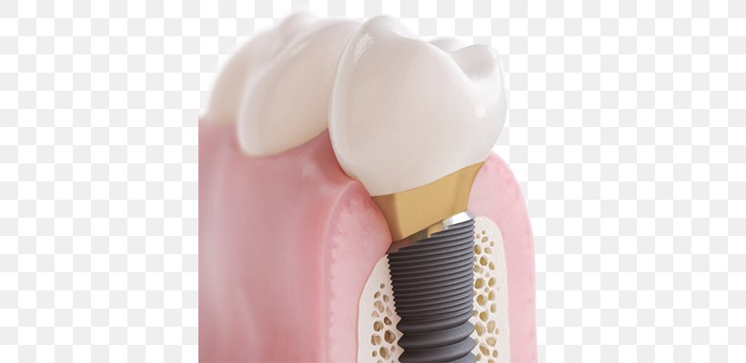 Dental Implant Cosmetic Dentistry Tooth, PNG, 741x400px, Dental Implant, Bridge, Brush, Cosmetic Dentistry, Crown Download Free