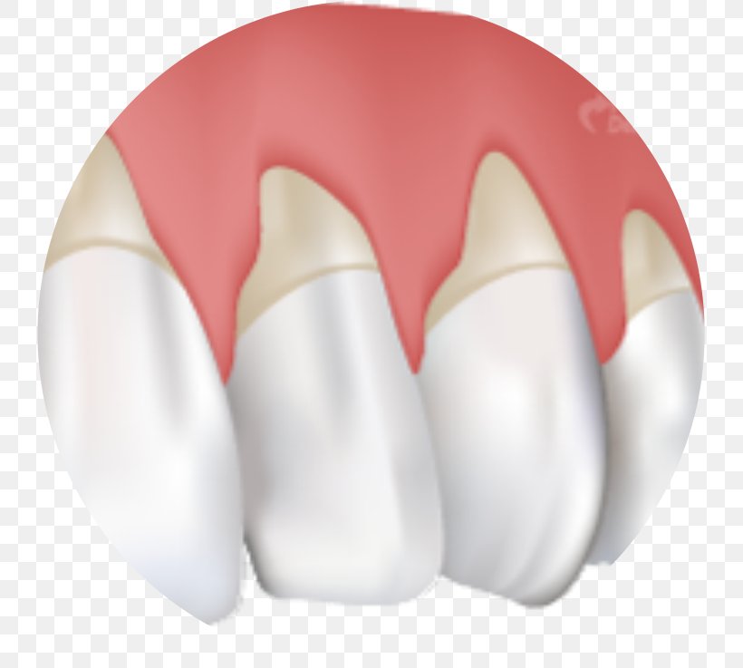 Gums Gingival Recession Gingivitis Periodontal Disease Cure, PNG, 737x737px, Gums, Bleeding On Probing, Cure, Dentistry, Gingival Graft Download Free