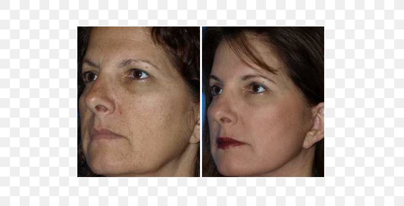 Light Eyebrow Fotoepilazione Laser Hair Removal, PNG, 597x420px, Light, Cheek, Chin, Close Up, Ear Download Free