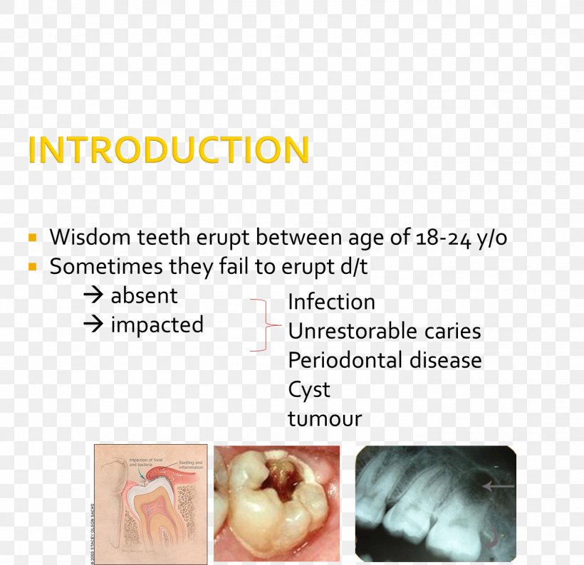 Wisdom Tooth Impacted Wisdom Teeth Tooth Impaction Jaw Molar, PNG, 1399x1355px, Wisdom Tooth, Far Infrared, Heat, Impacted Wisdom Teeth, Infrared Download Free