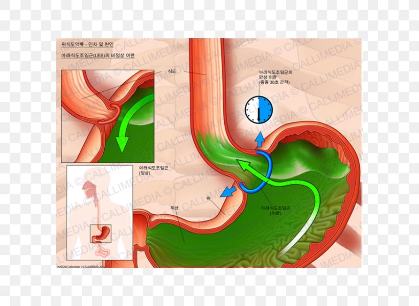 Esophagus Sphincter Cardia Sfintere Esofageo Inferiore Gastroesophageal Reflux Disease, PNG, 600x600px, Watercolor, Cartoon, Flower, Frame, Heart Download Free