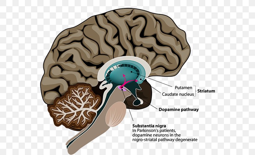 Parkinson's Disease Deep Brain Stimulation Neuroimaging, PNG, 562x500px, Disease, Brain, Cure, Deep Brain Stimulation, Dopamine Download Free