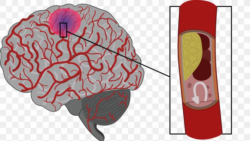 Stroke Brain Haemorrhage Agy Risk Factor, PNG, 1761x996px, Watercolor,  Cartoon, Flower, Frame, Heart Download Free