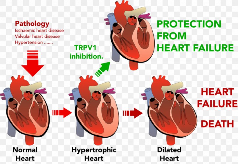 Heart Failure Ventricular Hypertrophy Cardiovascular Disease, PNG, 1000x691px, Watercolor, Cartoon, Flower, Frame, Heart Download Free