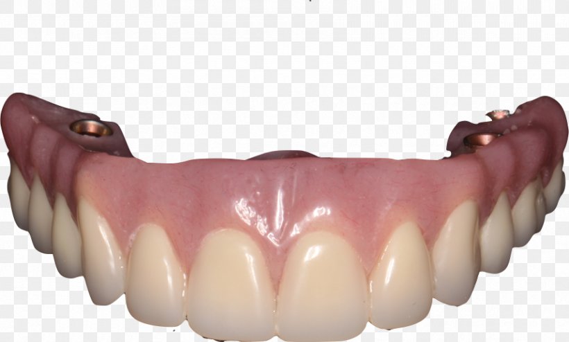 Tooth Dentures Dental Implant Removable Partial Denture, PNG, 858x517px, Tooth, Bridge, Clinic, Dental Implant, Dentistry Download Free