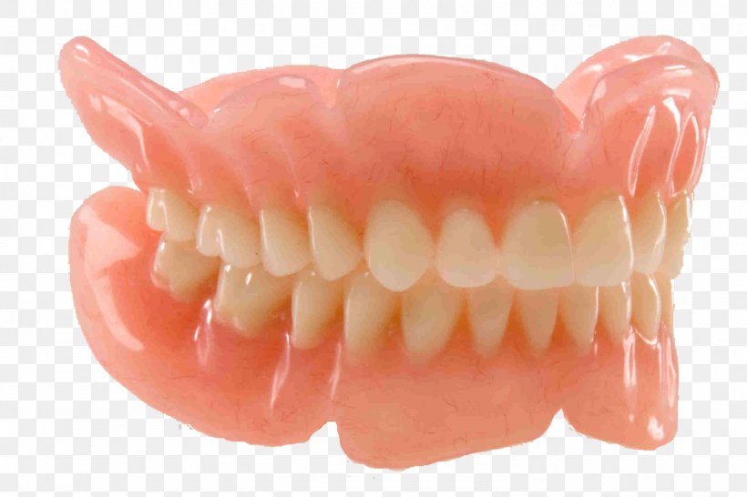 Dentures Dentistry Removable Partial Denture Dental Restoration, PNG, 1500x1000px, Dentures, Bridge, Crown, Dental Implant, Dental Restoration Download Free