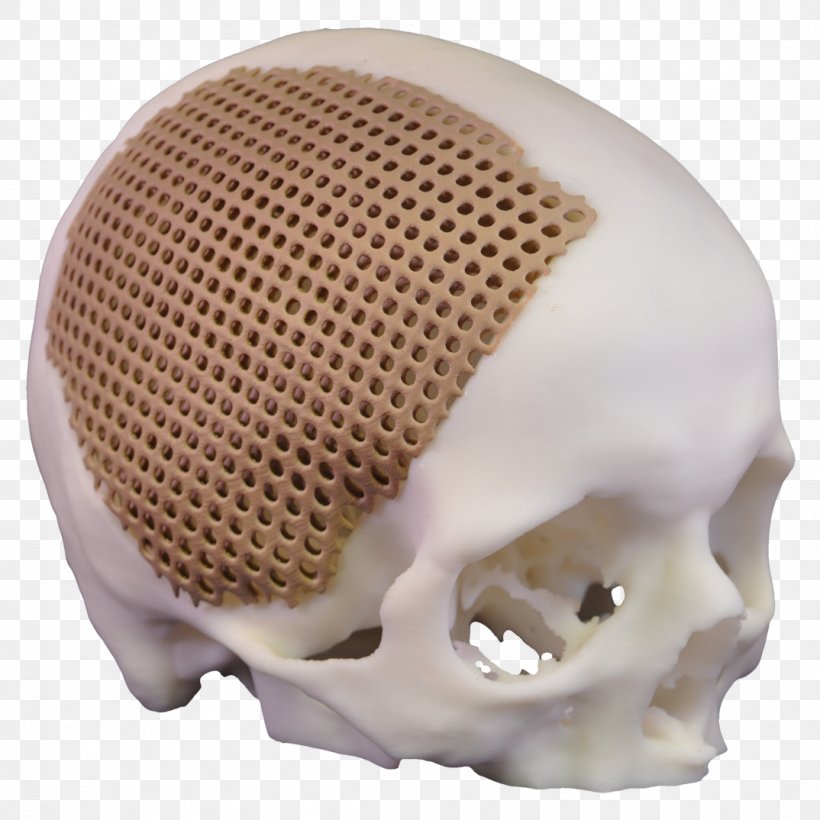 Xilloc Skull Bone Implant Jaw, PNG, 1074x1074px, Xilloc, Bone, Computed Tomography, Dental Implant, Head Download Free