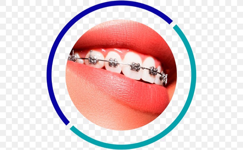 Orthodontics Dentistry Dental Braces Tooth, PNG, 507x508px, Orthodontics, Body Jewelry, Clear Aligners, Clinic, Cosmetic Dentistry Download Free