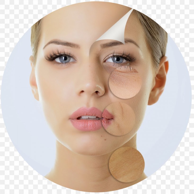 Chemical Peel Skin Wrinkle Facial Exfoliation, PNG, 1140x1140px, Chemical Peel, Blepharoplasty, Botulinum Toxin, Cheek, Chin Download Free