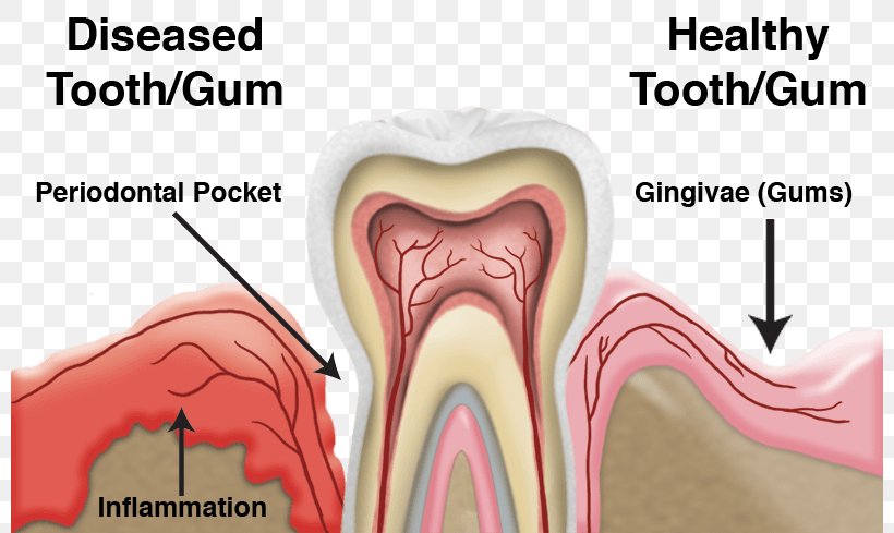 Tooth Periodontal Disease Dentistry Gums, PNG, 800x489px, Watercolor, Cartoon, Flower, Frame, Heart Download Free