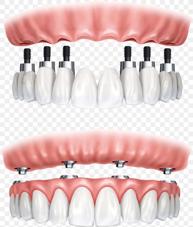 All-on-4 Dental Implant Dentistry Dentures, PNG, 945x1114px, Watercolor, Cartoon, Flower, Frame, Heart Download Free
