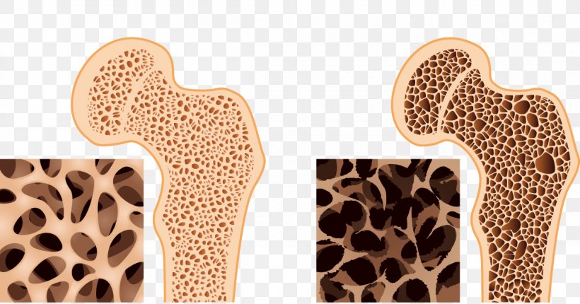 Bone Density Osteoporosis Bone Health Osteopenia, PNG, 1200x630px, Bone Density, Back Pain, Bone, Bone Disease, Bone Fracture Download Free