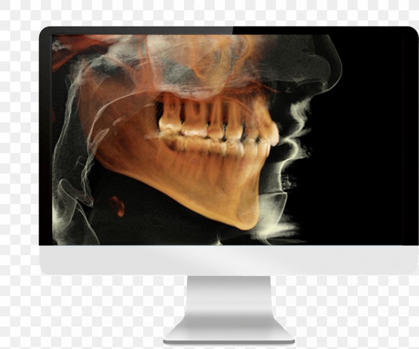Cone Beam Computed Tomography Dental Radiography Dentistry, PNG, 1172x978px, Cone Beam Computed Tomography, Bone, Brand, Computed Tomography, Dental Radiography Download Free