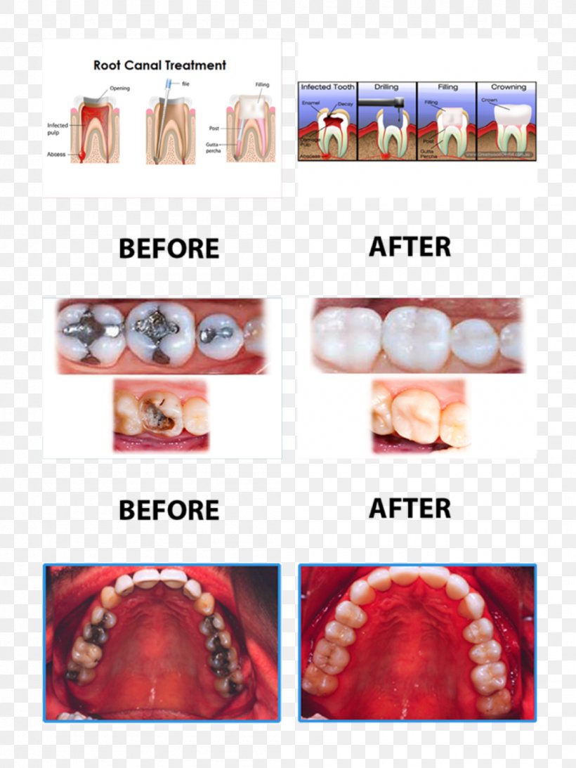 Surgery Dentistry Root Canal Dental Extraction Png 1050x1400px